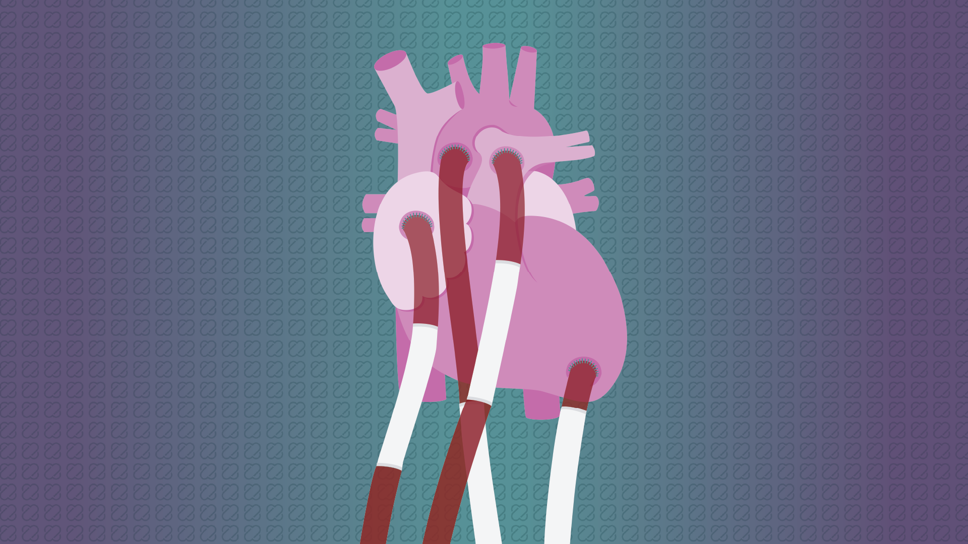 RVAD timing in pediatric BiVAD support
